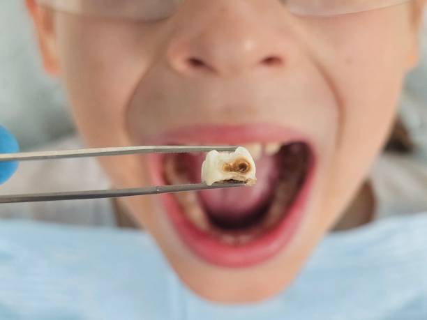 Best Emergency Wisdom Teeth Removal in Cleveland, OK